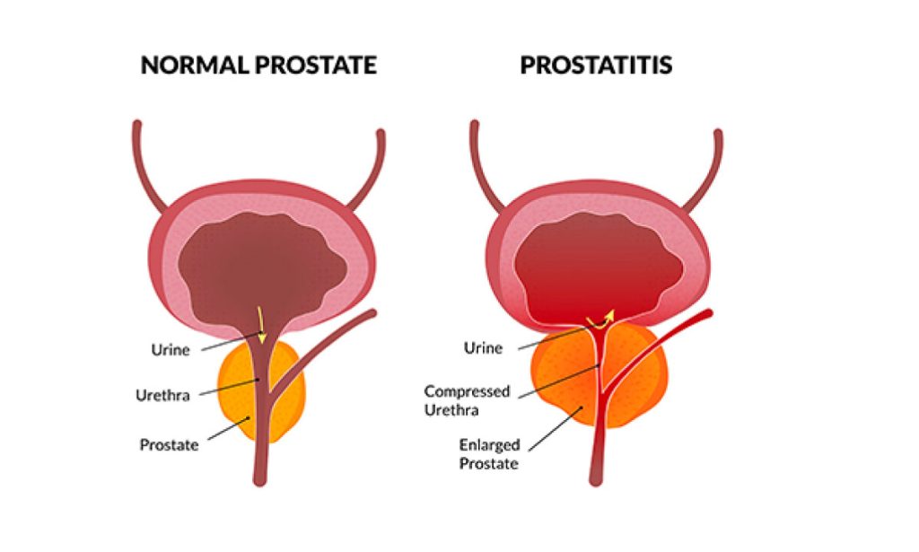پروستاتیت چیست؟