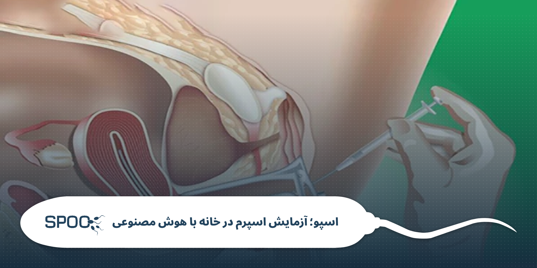 زمان‌بندی و چرخه قاعدگی برای موفقیت IUI