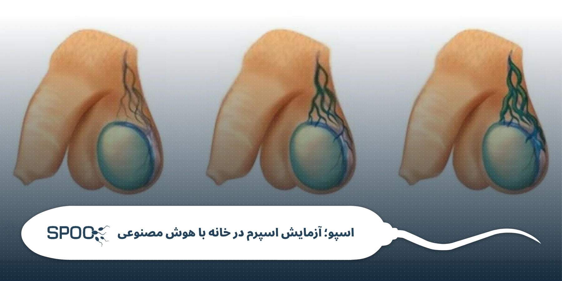 واریکوسل گرید ۳ چیست و چقدر روی اسپرم تاثیر دارد؟