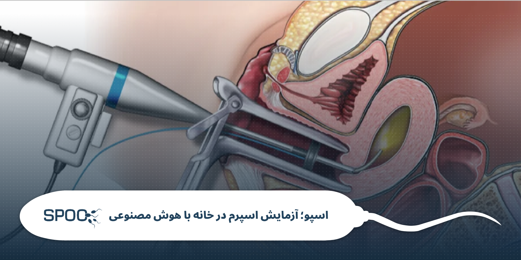 تعیین جنسیت با IUI چگونه انجام می‌شود؟