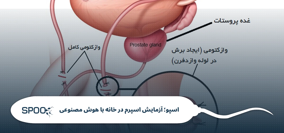 دلایل و مواقع انجام وازکتومی