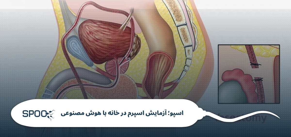 آیا پس از وازکتومی امکان بچه‌دار شدن وجود دارد؟